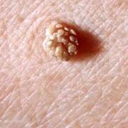 žmogaus papilomos virusas ant odos