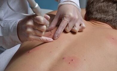 papilomų pašalinimo būdai