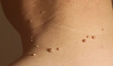 papilomų priežastys