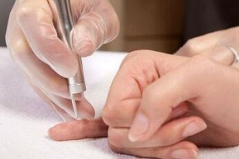 kaip atsikratyti papilomų ant kūno