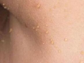 papilomų atsiradimo ant kūno priežastys