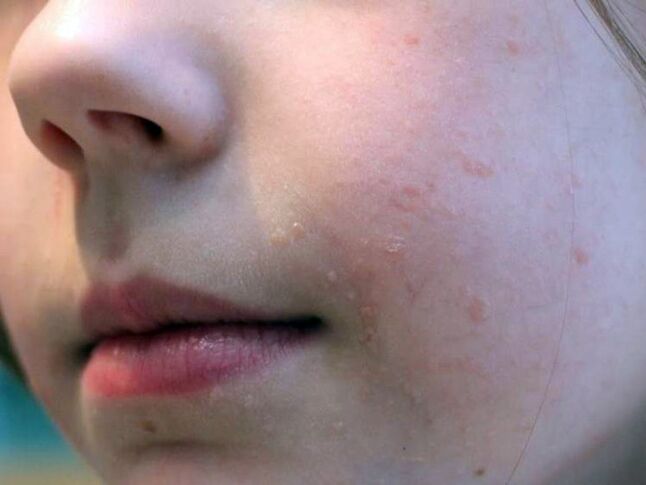 Plokščios karpos ant veido dažniausiai atsiranda paauglystėje